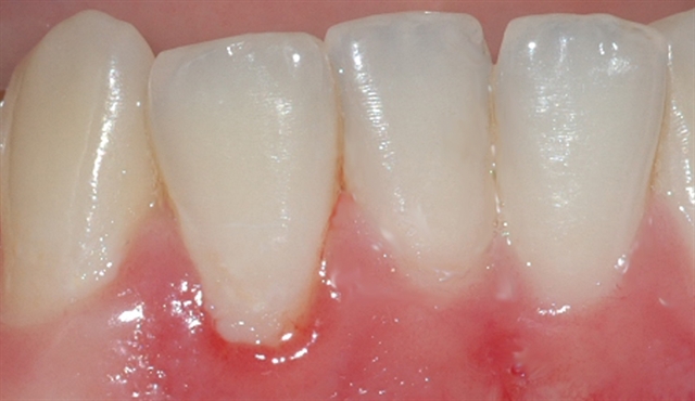 gingivitt Pasient 1 1