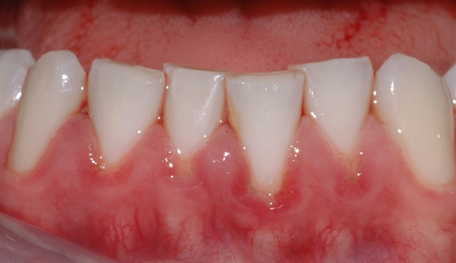 gingivitt pasient 3 1