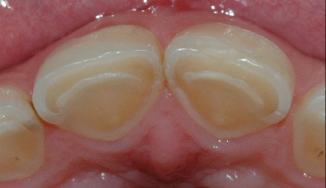 syreskader front palatinalt