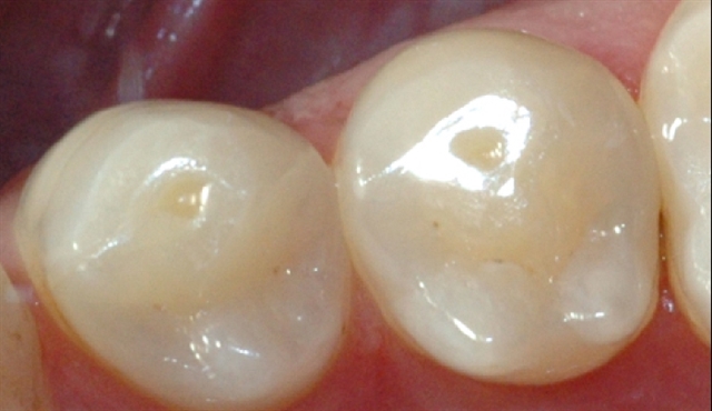 syreskader premolar pitting